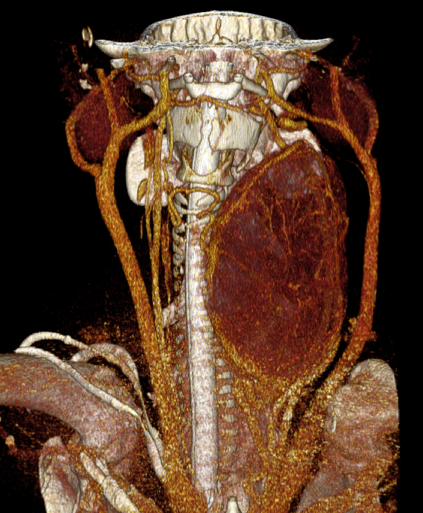 CT Thyroid Neck Mass